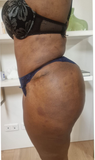 Nach der Abdominoplastik, Fall 4