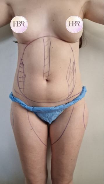 Vor dem Lipofilling des Gesäßes, Fall 4