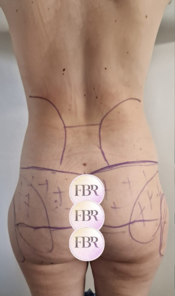Vor dem Lipofilling des Gesäßes, Fall 5