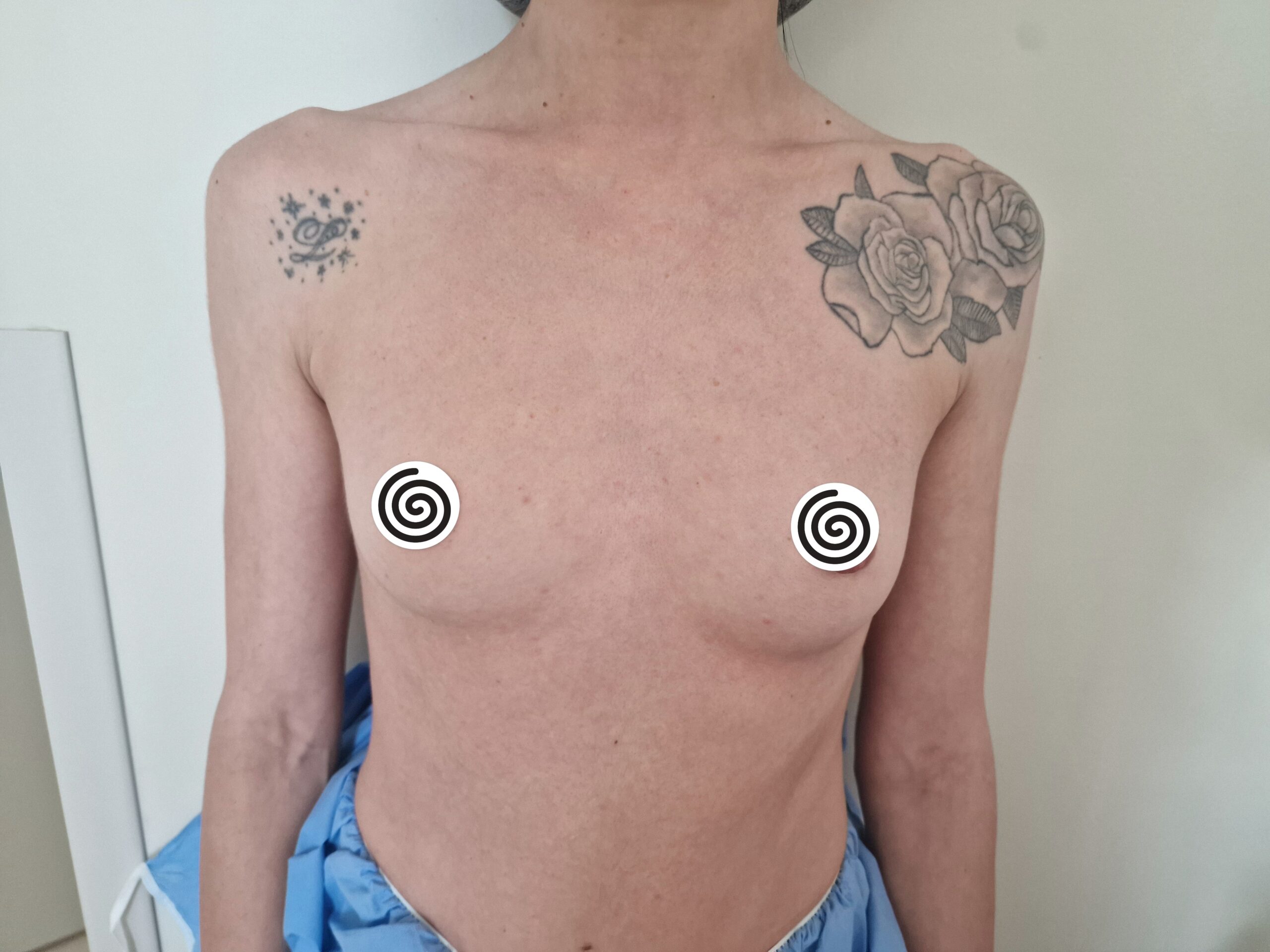 Vor dem Brust-Lipofilling, Ausgangszustand der Brust