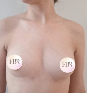 Before breast augmentation with implants