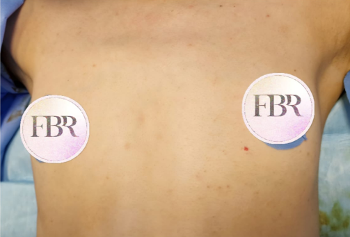 Before breast augmentation with implants