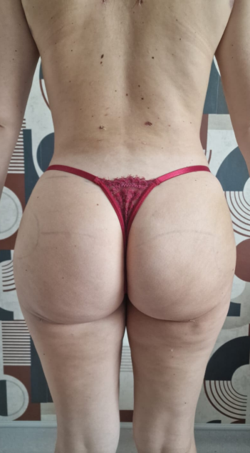 After buttock fat grafting — case 5