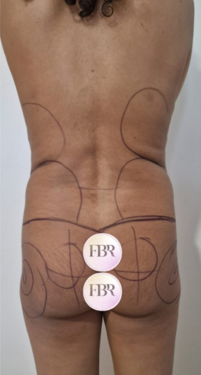 Before buttock fat grafting — case 7
