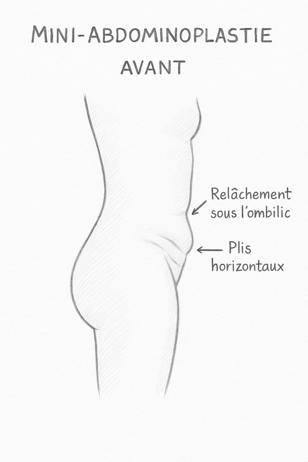 Before mini tummy tuck (mini-abdominoplasty)