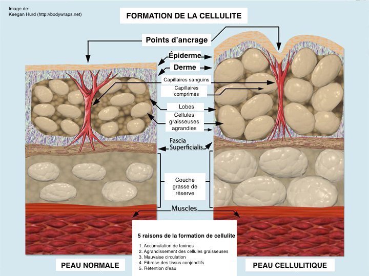 Esquema pedagógico de los factores del aspecto acolchado de la celulitis