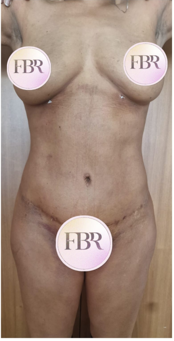 Después de la abdominoplastia, caso 2