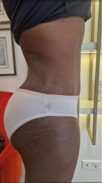 Después de la abdominoplastia, caso 6