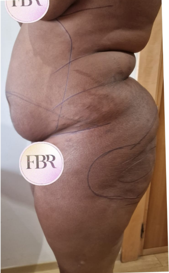 Antes de la abdominoplastia, caso 4