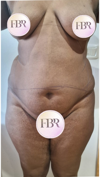 Antes de la abdominoplastia, caso 5