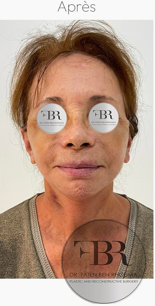Después del lifting facial