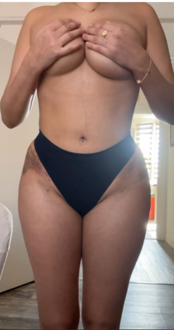 Después del lipofilling de glúteos, caso 3