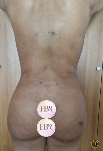 Après lipofilling des fesses — cas 7