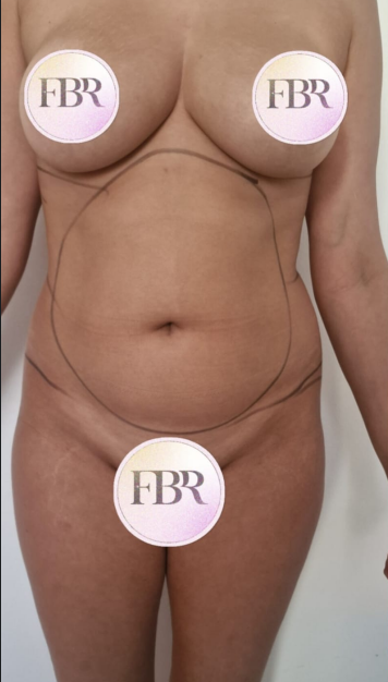 Prima del lipofilling dei glutei, caso 3