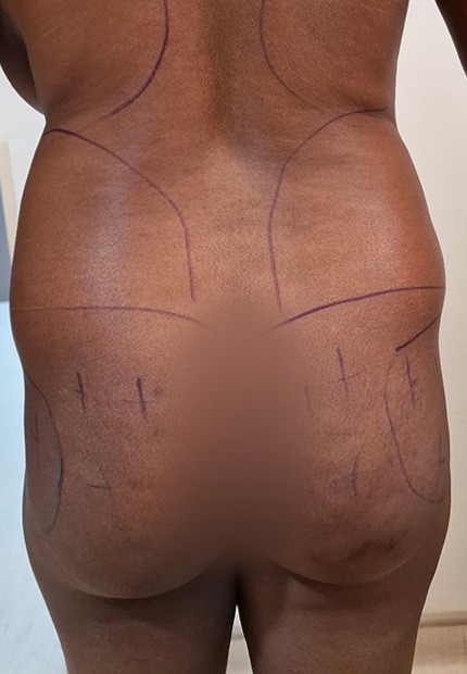 Prima del lipofilling dei glutei