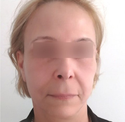 Après blépharoplastie - Résultat après intervention chirurgicale des paupières