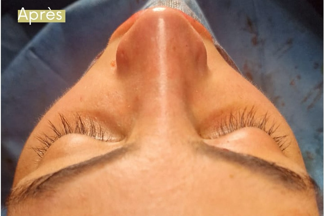 after ‣ Dr Faten Ben Rhouma - Site officiel Après rhinoplastie - Résultat après intervention chirurgicale du nez