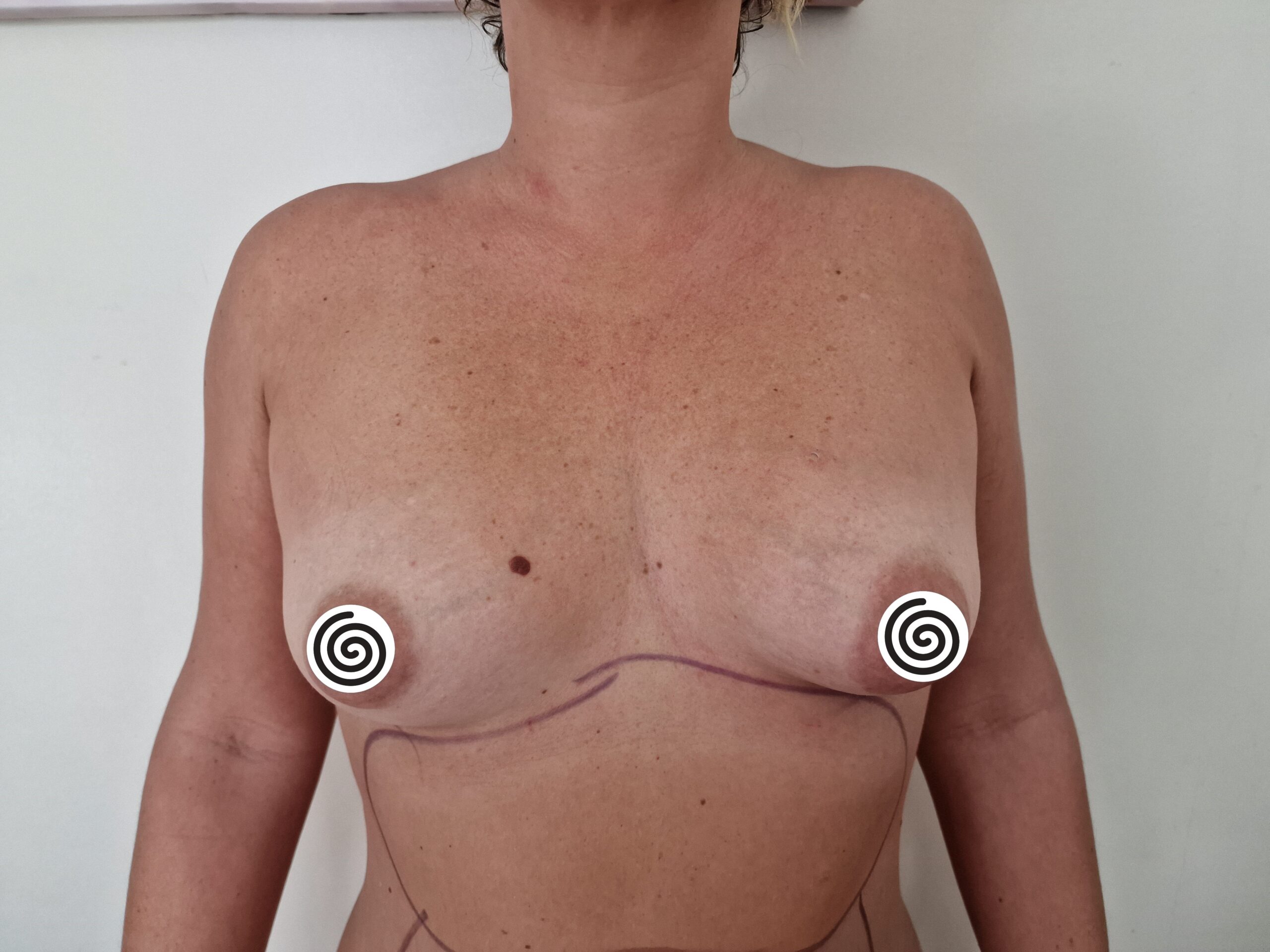 Avant Augmentation Mammaire - État initial