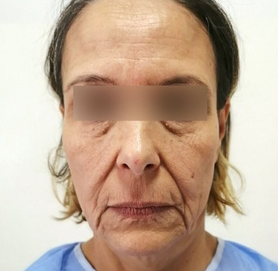 Avant blépharoplastie - État initial des paupières avant intervention chirurgicale