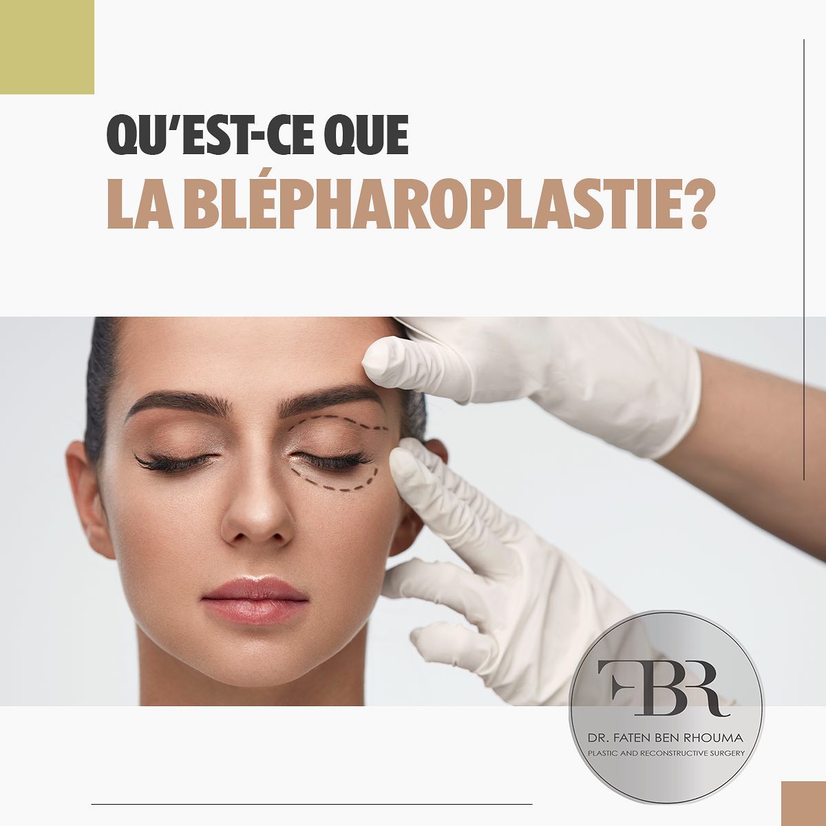 Schéma de blépharoplastie - Intervention chirurgicale des paupières pour rajeunir le regard