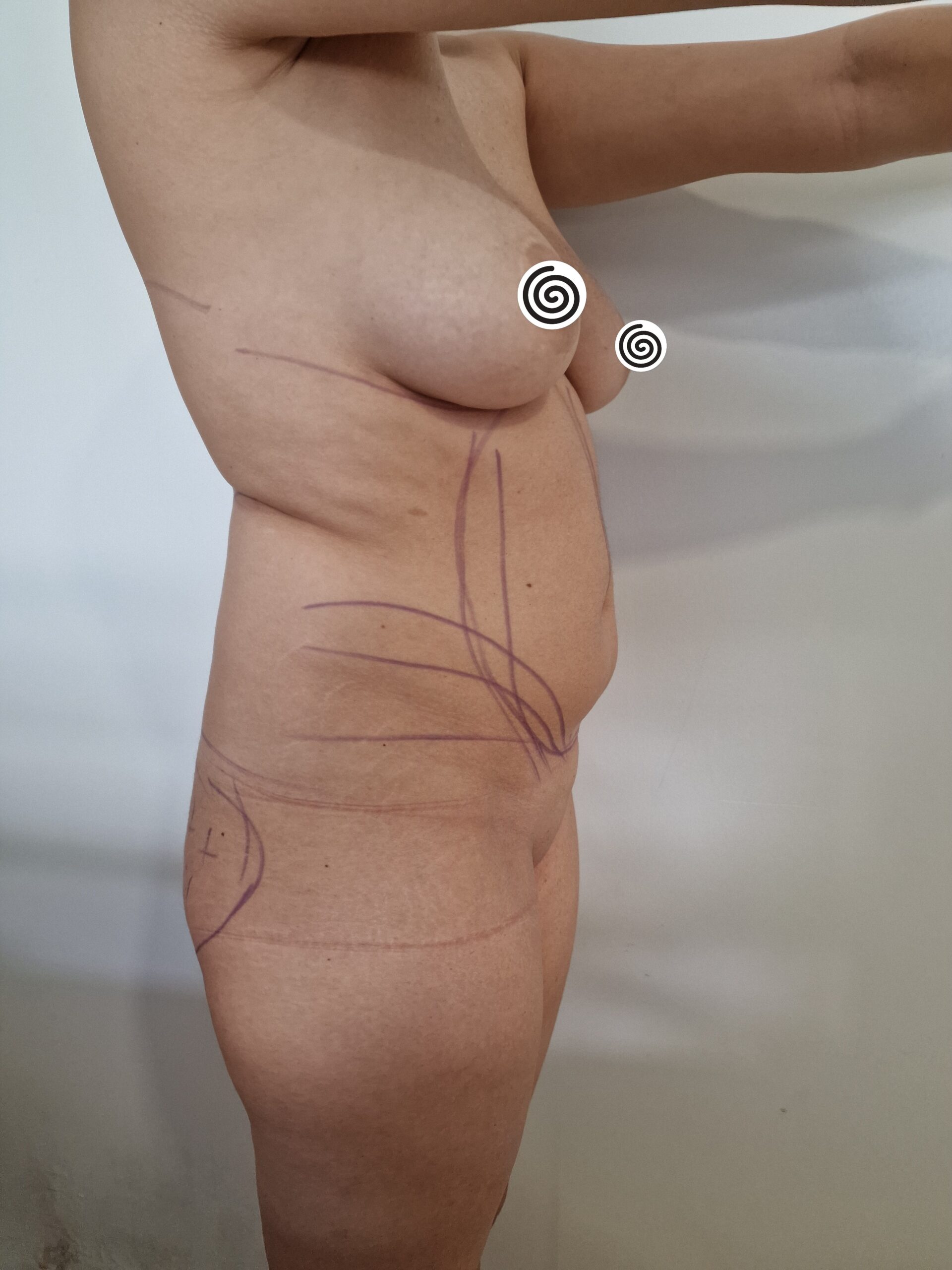 Avant lipofilling des fesses - État initial