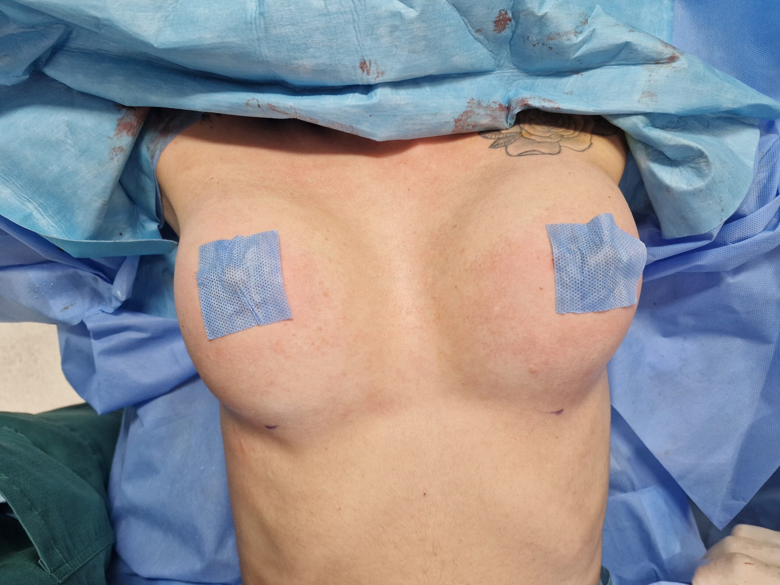 Après lipofilling mammaire - Résultat après intervention chirurgicale pour augmenter le volume mammaire