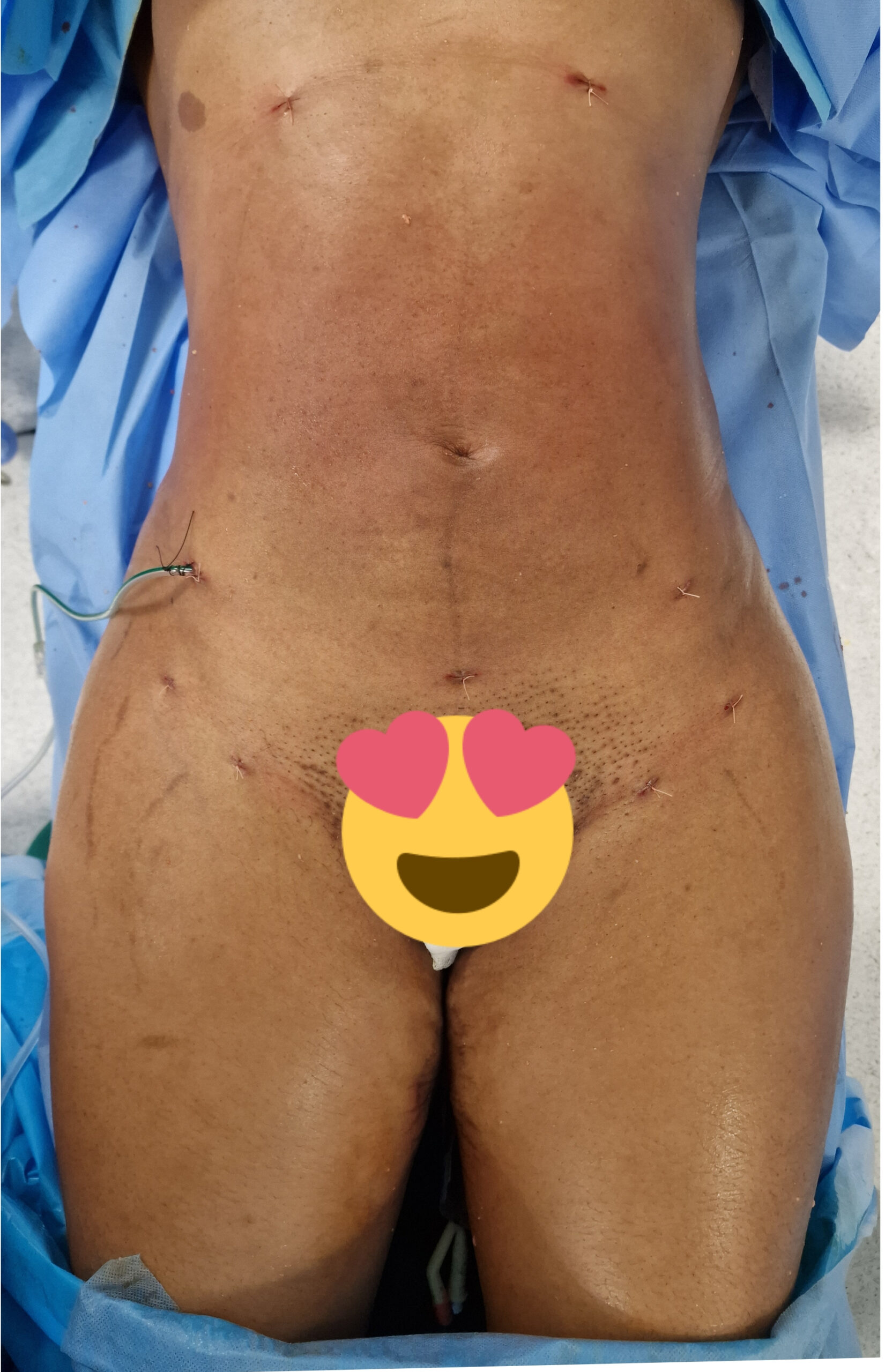 Après liposuccion - Résultat après intervention chirurgicale