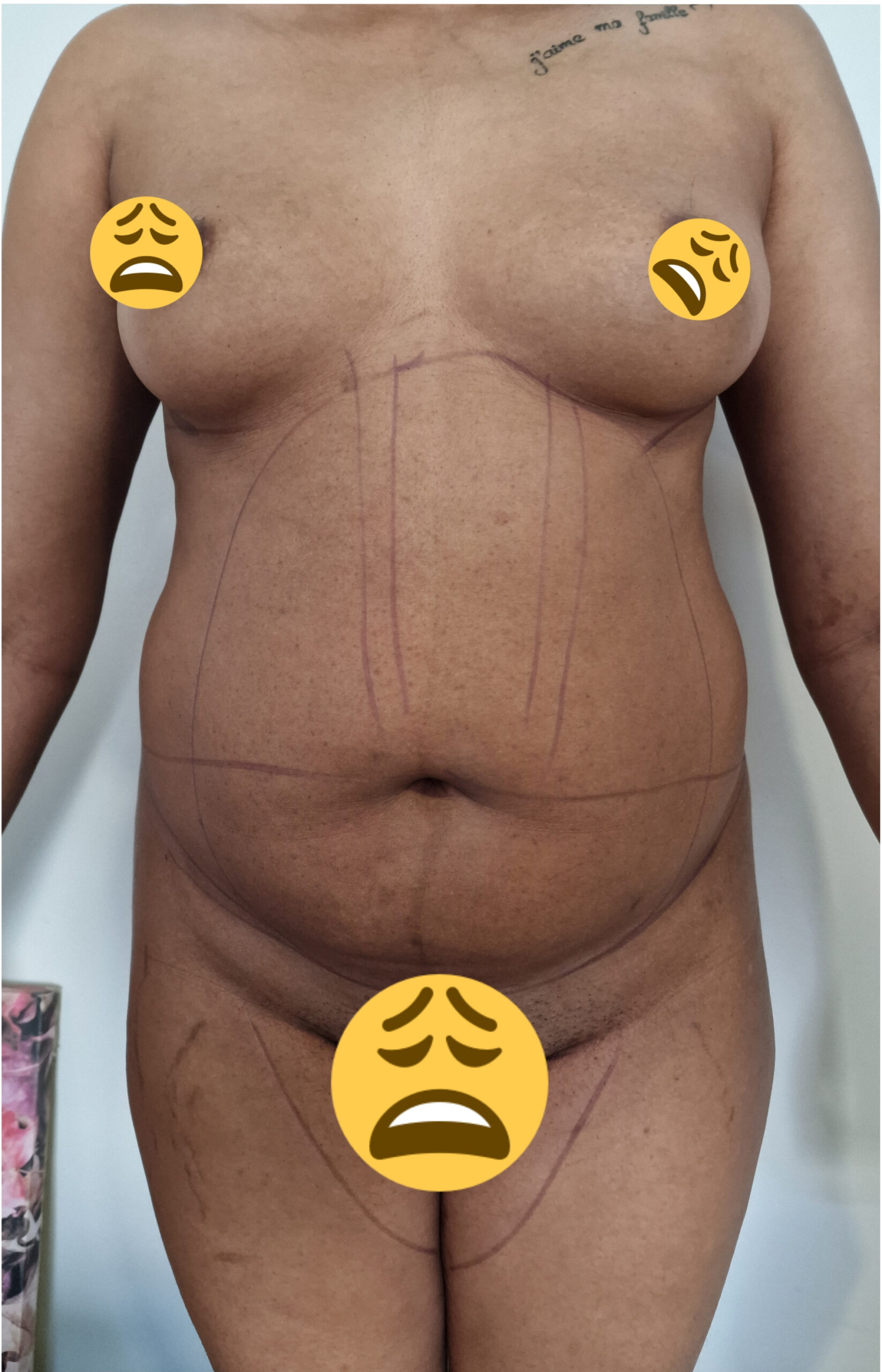 Avant liposuccion - État initial avant intervention chirurgicale