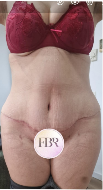 Après Abdominoplastie — illustration 3