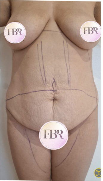 Avant Abdominoplastie — illustration 3